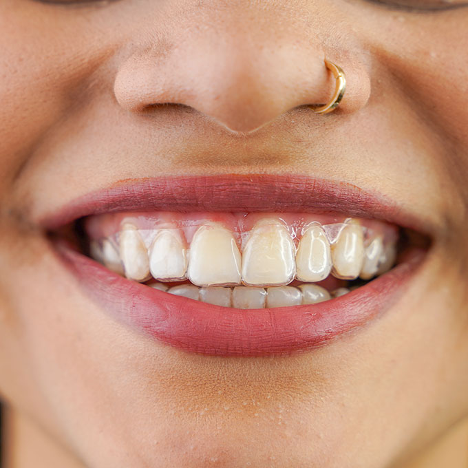 Smiling woman wearing Invisalign to straighten her teeth
